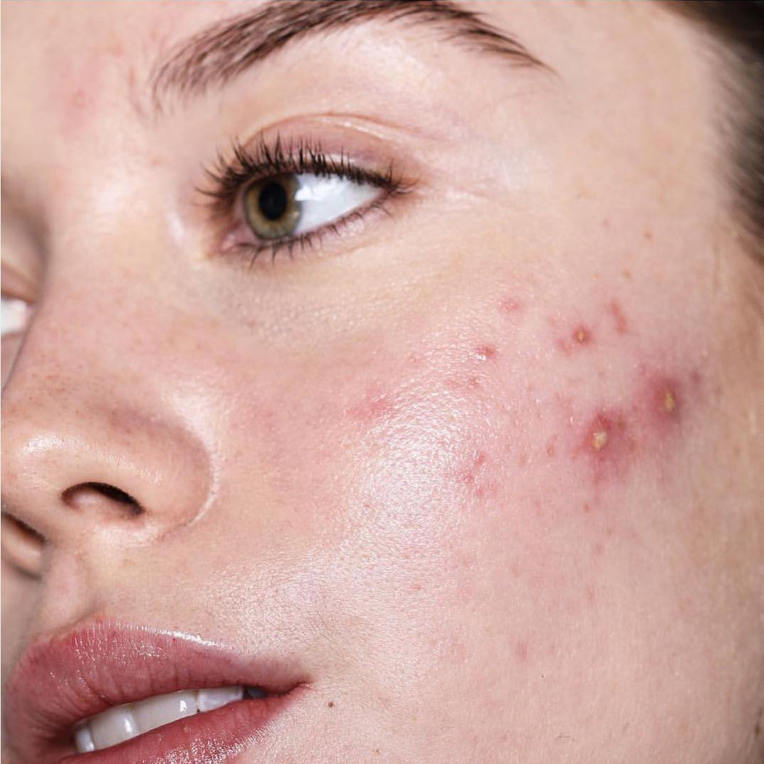 Acne Care (Oily Skin)